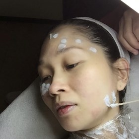 How To Remove Warts On Face: Ellen Paul